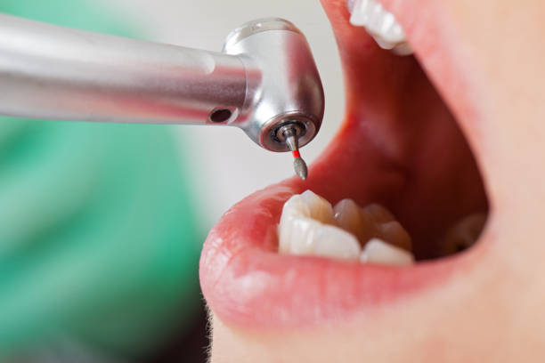 Best Emergency Root Canal Treatment in Marissa, IL